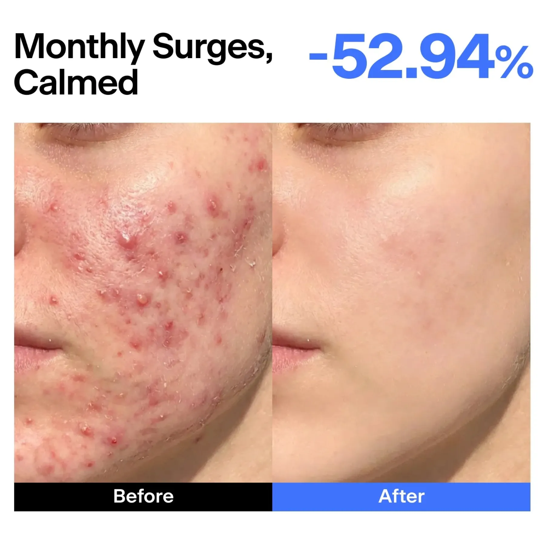Hot ABC Triple-synergy Redness Comfort Serum Alle Korean Skincare|Anti-Unreinheiten-Serum