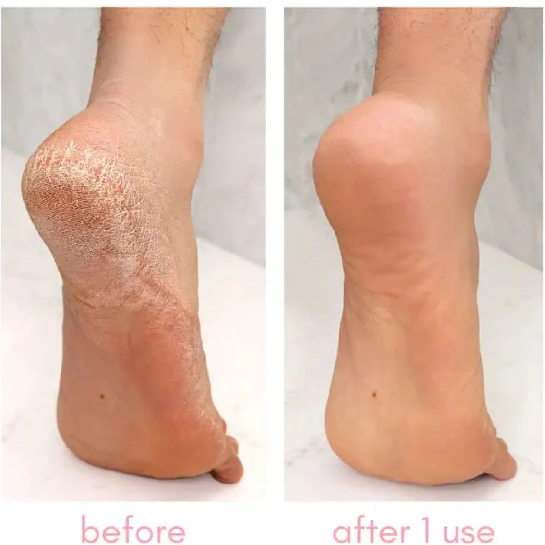 Best Heel-ing Callus Remover Vegan Pflege|Fußpflege