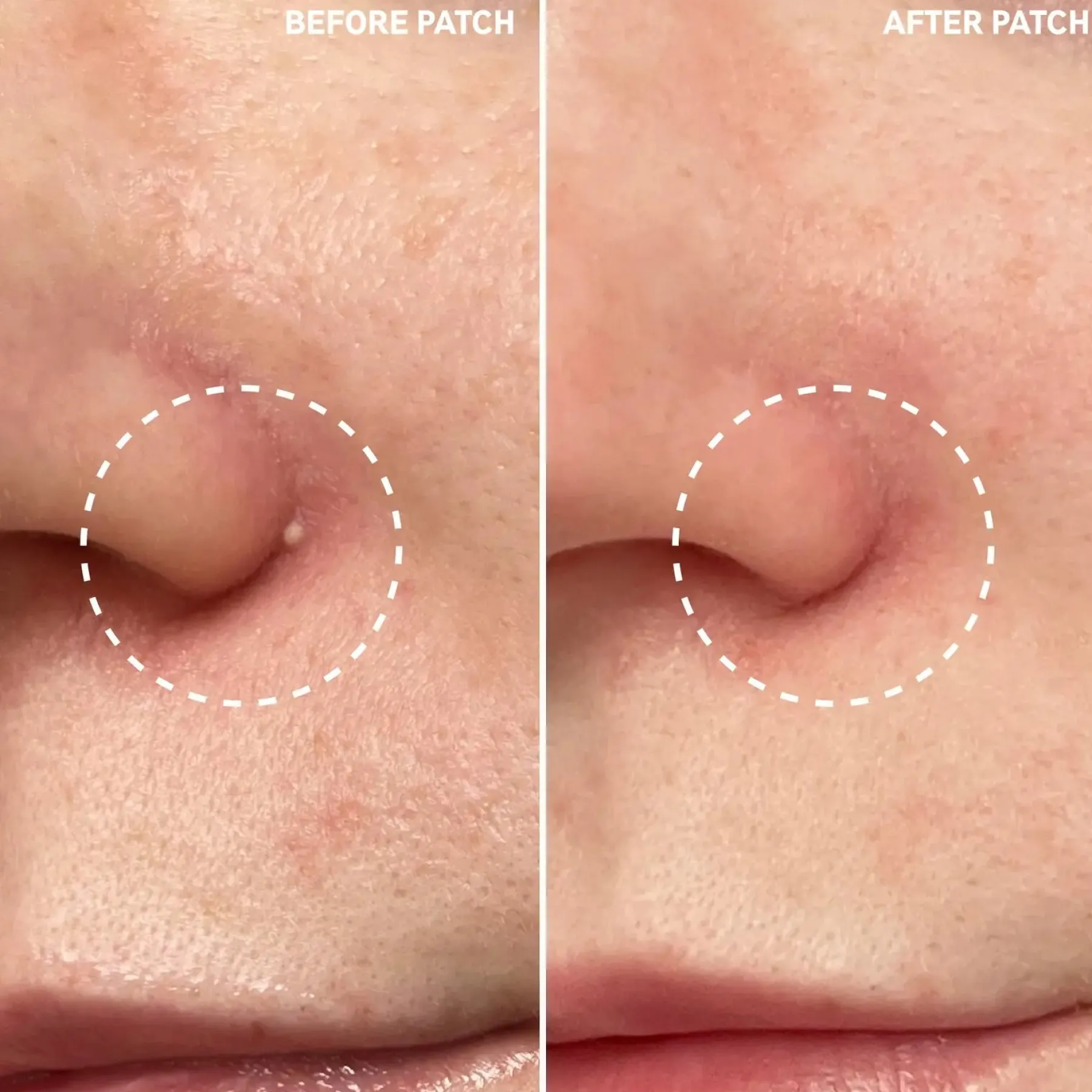 Clearance Hydrocolloid Invisible Pimple Patches Vegan Pflege