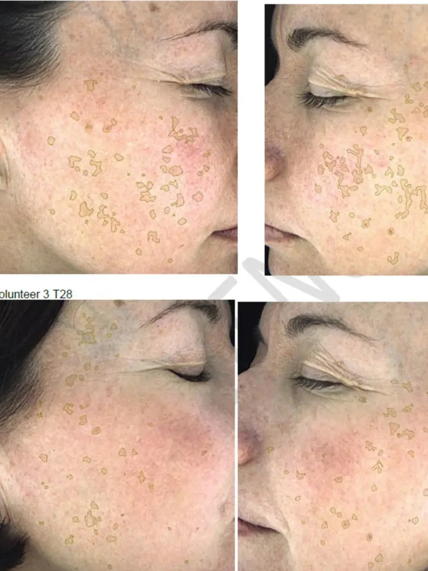 Hot Hyperpigmentation Serum - 2% Alpha Arbutin + 1% Kojic Acid Vegan Pflege|Problemlösende Seren