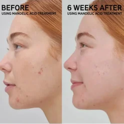 Discount Mandelic Acid Treatment Vegan Pflege