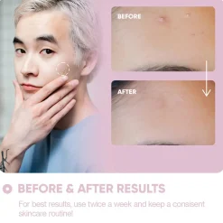 Outlet Micro Needle Patches For Dark Spots Vegan Pflege|Hautprobleme