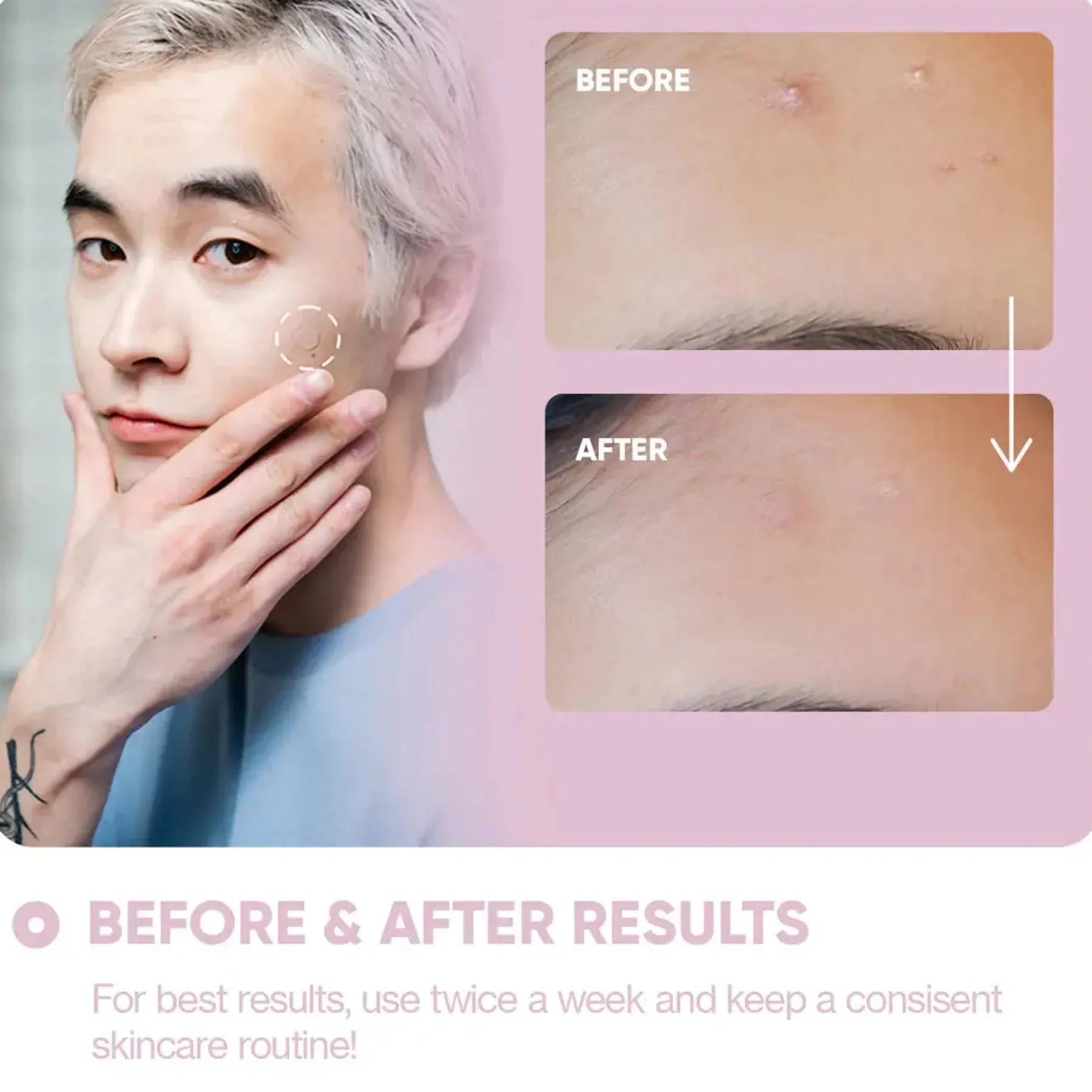 Outlet Micro Needle Patches For Dark Spots Vegan Pflege|Hautprobleme