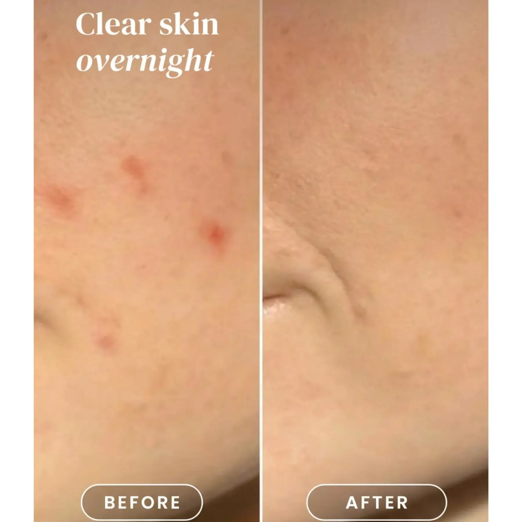 Clearance Pimple Patches Vegan Pflege|Hautprobleme