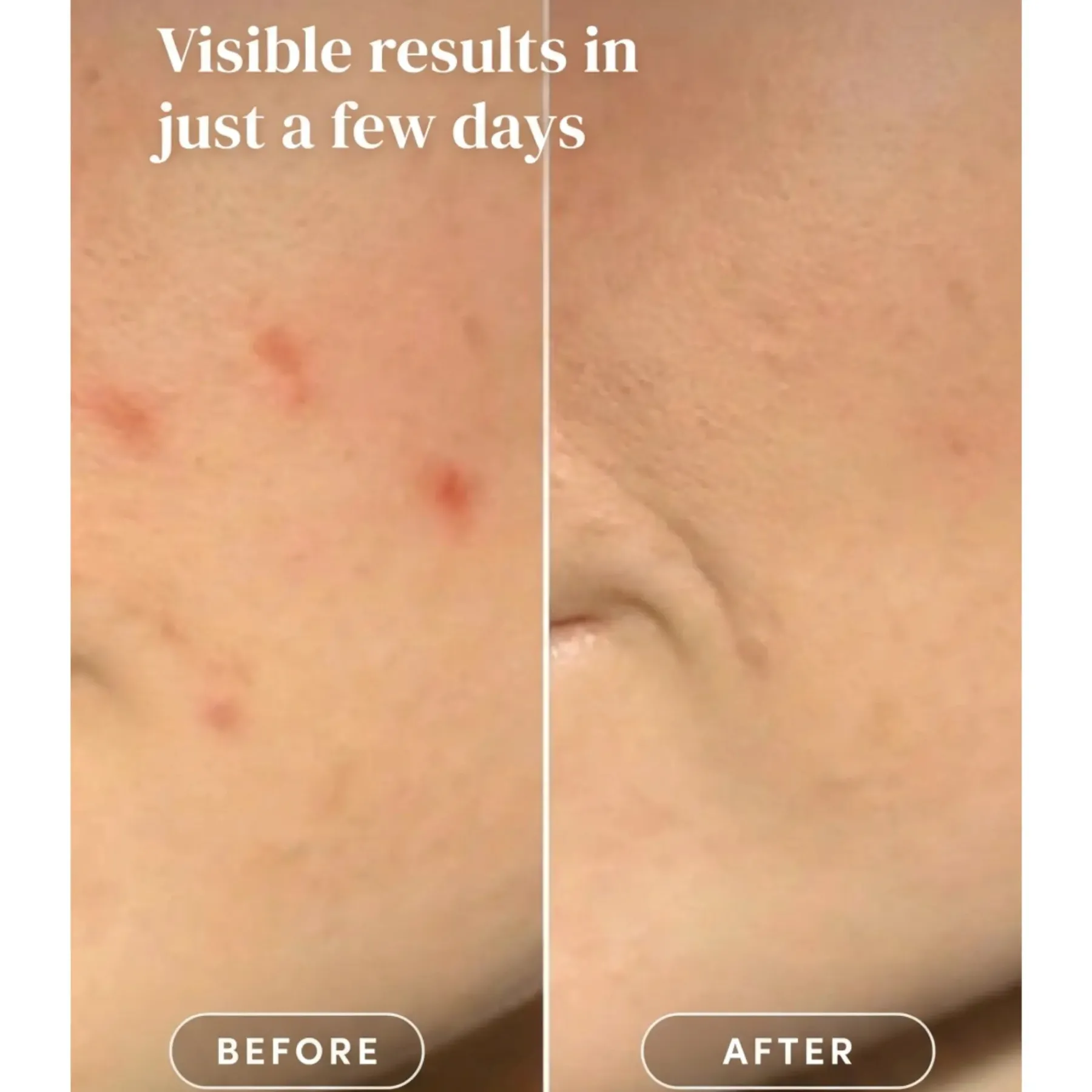 Discount Post Pimple Patches Vegan Pflege|Pickelpflaster