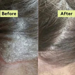 Outlet Scalp-Eaze Scalp Balm Amla Berry & Mango Butter Hair Growth|11 Schritte Haarpflege Routine