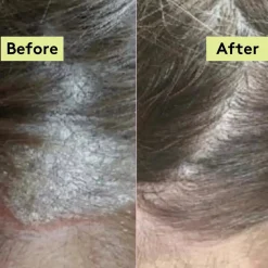 Best Scalp-Eaze Scalp Balm Amla Berry & Mango Butter Hair Growth|11 Schritte Haarpflege Routine