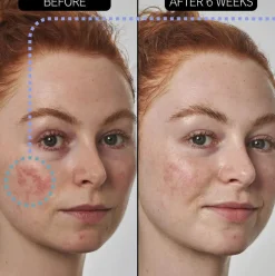 Sale SuperSolutions Redness Relief Solution Vegan Pflege