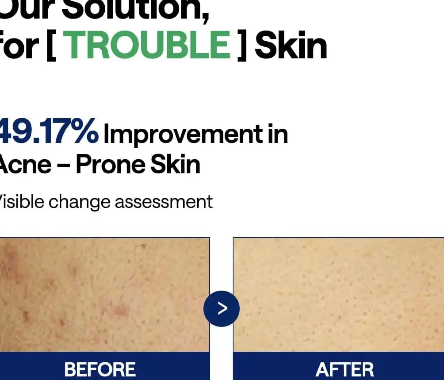 Outlet Teatree Trouble Pad Toner Pads|Vegan Pflege