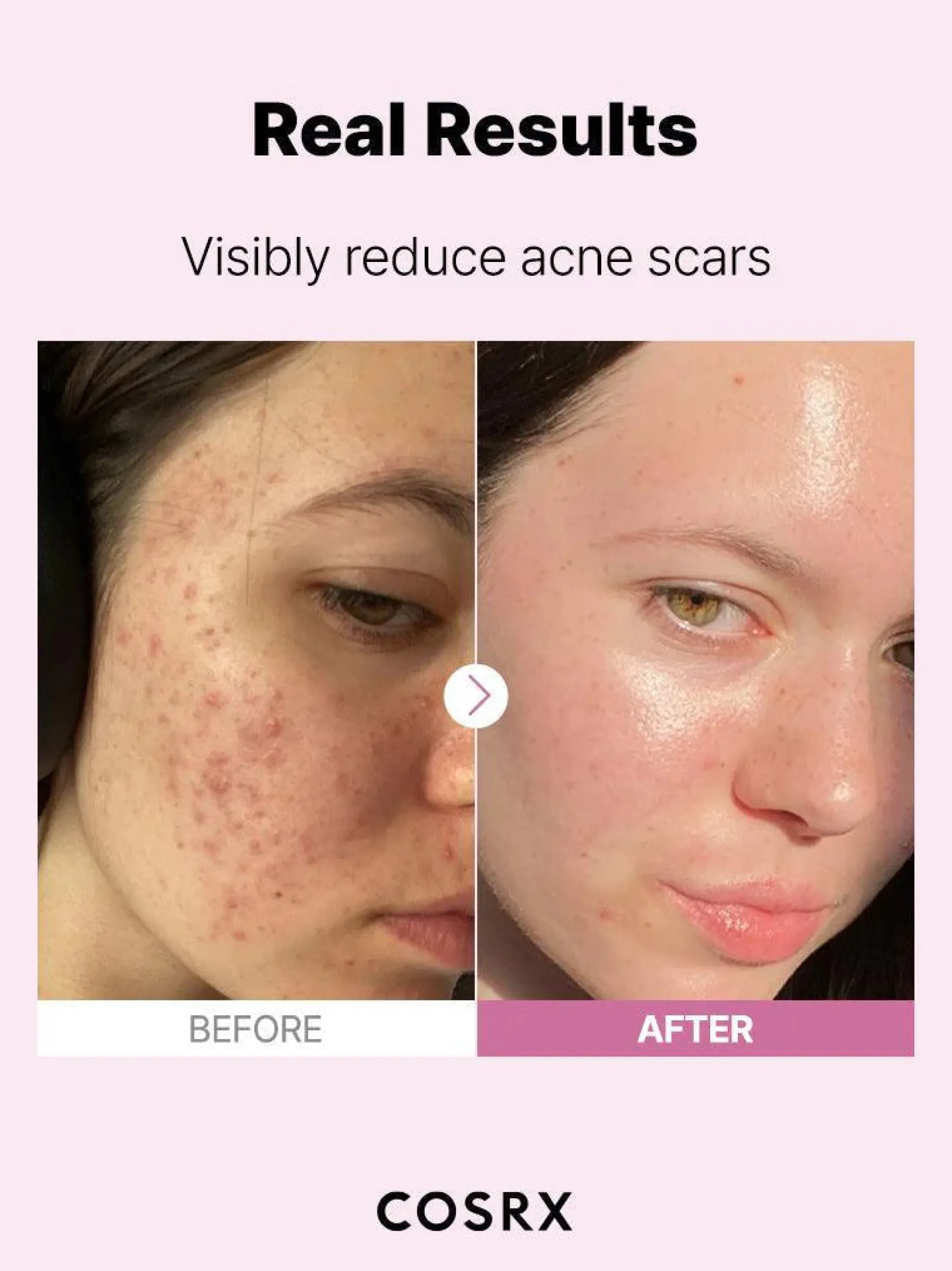 Sale The Niacinamide 15 Serum Hauptzutat|Anti-Unreinheiten-Serum