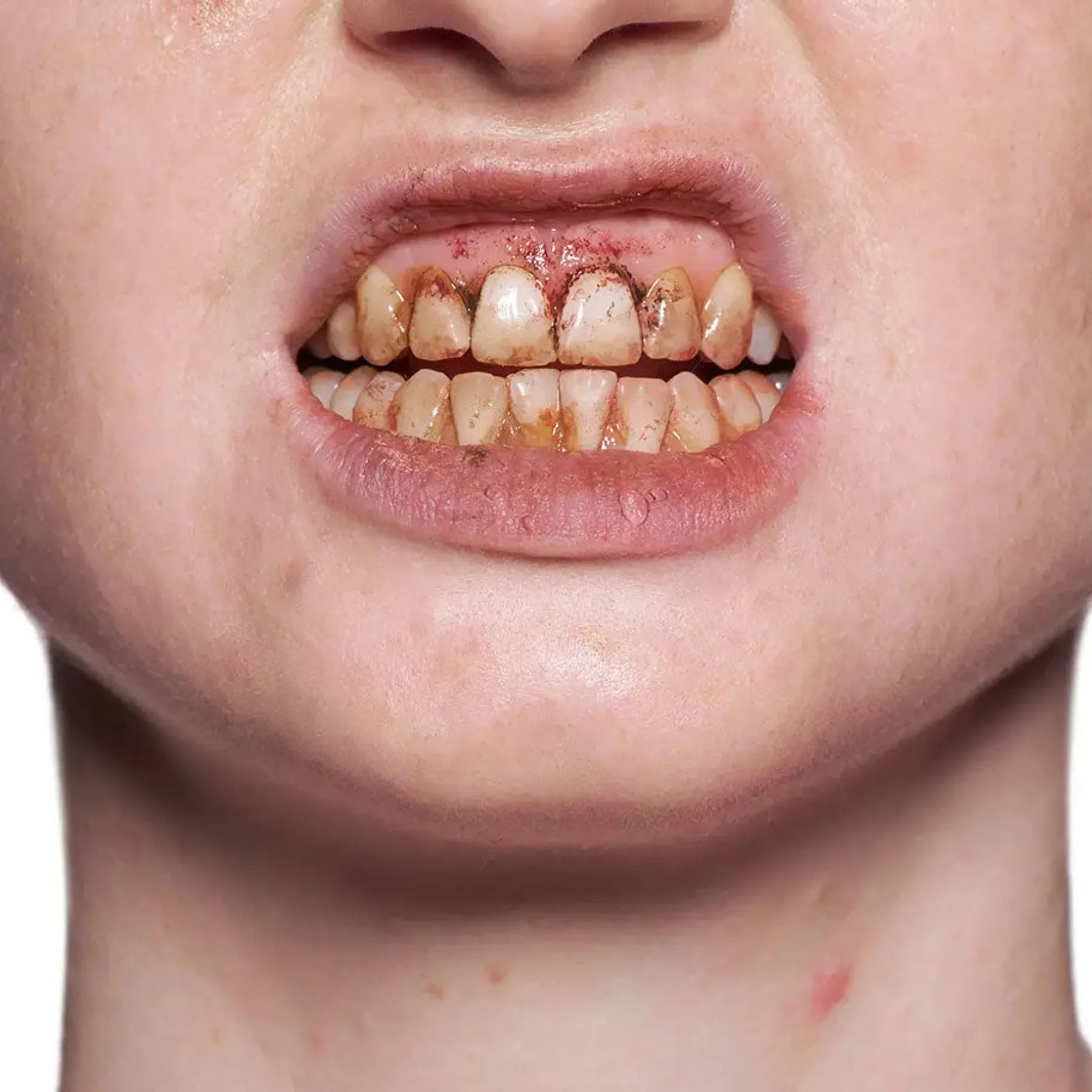 Clearance Tooth Enamel Red Spezialeffekte Make-Up