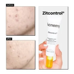 Outlet Zitcontrol Treatment Cream Vegan Pflege